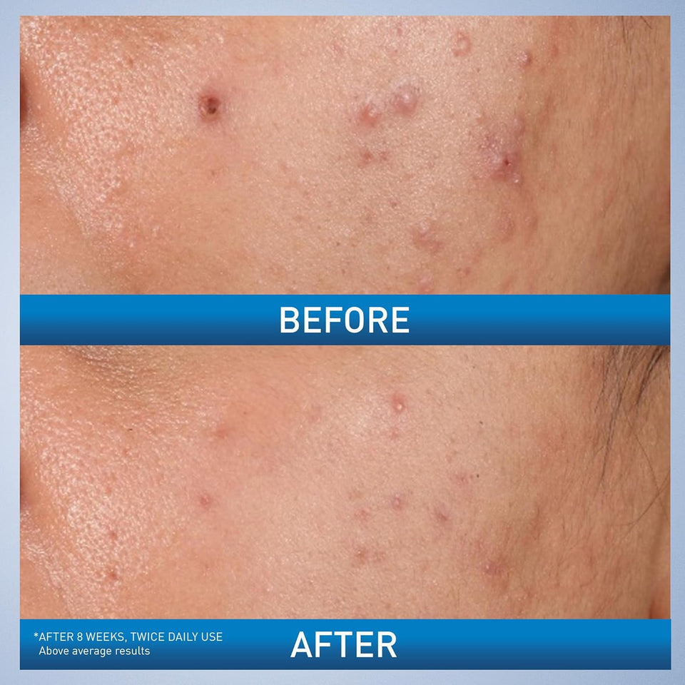 CeraVe Acne Control Gel 2% Salicylic Acid with Niacinamide & AHA for Blemish Treatment 1.35 Oz