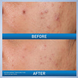 CeraVe Acne Control Gel 2% Salicylic Acid with Niacinamide & AHA for Blemish Treatment 1.35 Oz